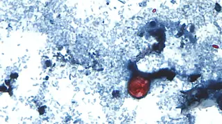 Ohio's cyclosporiasis tally tops 4,000 as outbreak widens across 45 states