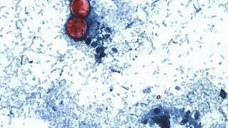 Lettuce-linked cyclospora outbreak expands to Georgia, Tennessee and Texas