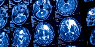 Lifelong light drinking and aging jointly linked to lower brain blood flow and thinner cortex