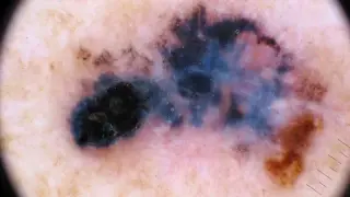 Personalized cancer vaccine from Moderna and Merck shows breakthrough in melanoma