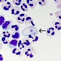 Louisiana reports rare brain-eating amoeba case linked to Lake Claiborne