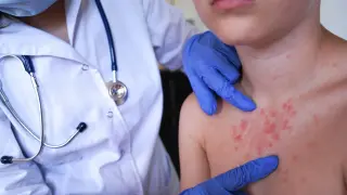 Delaware Logs First Measles Case in Over a Decade Amid Neighboring Outbreak
