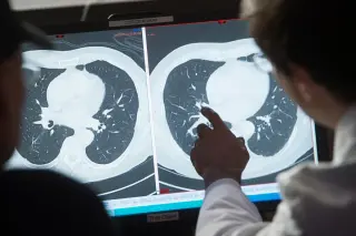 Cancer drug erases tumors in chemo-resistant cancers, early trial results show