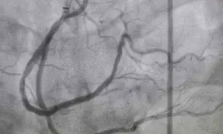 Post-thrombectomy drug enhances stroke recovery by clearing downstream brain vessels