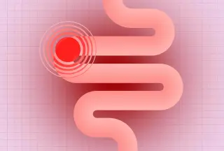 Study Finds Specific Ultra-Processed Foods, Not Total Intake, Drive Colon Cancer Risk