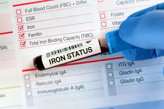 ASH Guidelines Raise Ferritin Cutoffs to Detect Iron Deficiency Before Anemia
