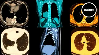 Intercepting Lung Cancer: Could a Pill Stop It Before It Starts?