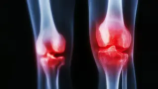 New Study Shows Dissolving Microspheres Offer Year-Long Knee Pain Relief