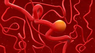 Rise in incidental brain aneurysms among healthy adults prompts targeted screening debate