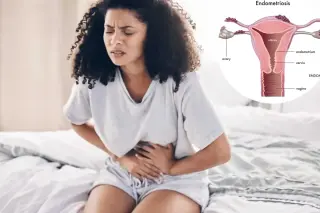 Beyond Painful Periods: Experts Highlight Fatigue and 'Endo Belly' as Key Endometriosis Indicators