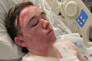 Co-Worker Allegedly Throws Hot Oil, McDonald’s Employee in ICU