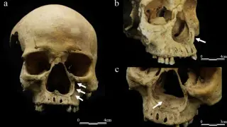 First Archaeological Proof of Nose-Cutting Punishment in Ancient China