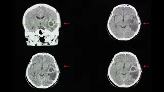 CDC Flags Fourfold Surge in Rare, Fatal Brain Fungal Infections
