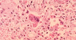 Georgia Measles Outbreak Tied to Metro Atlanta Daycare Expands