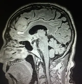 Independent Review Finds No Brain-Tumor Cluster at Newton-Wellesley Hospital