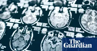 Trump-Era Funding Cuts May Withhold Alzheimer’s Study Results From Participants