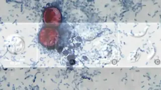 Iowa’s cyclosporiasis cases rise to 226 overall, Polk County at 32
