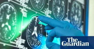 Alzheimer’s Research Cited in NIH Cancellations Amid DEI Debates