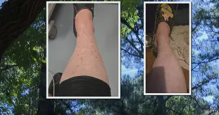 Tick bite mystery in NC: RMSF and other infections under investigation