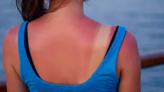 A Single Severe Sunburn in Youth Linked to Higher Skin Cancer Risk