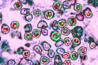 Unvaccinated PA woman dies from measles amid outbreak and policy clash