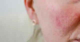 Rosacea Demystified: Triggers, Symptoms, and Treatments