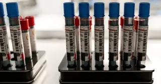 Alzheimer's blood tests spark debate over predicting risk and guiding care