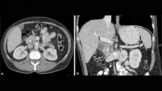 Daraxonrasib Goes to Patients Early Through Expanded Access Ahead of FDA Decision