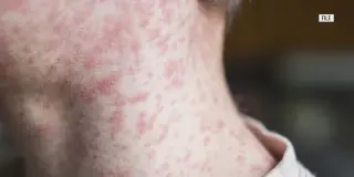Wood County Confirms Measles Case with Exposure Sites in Bowling Green