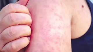 Ohio Measles Cases Reach 133 as Portage County Confirms First Infection