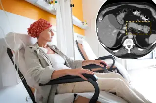 Mayo Clinic AI flags pancreatic cancer years before scans reveal it