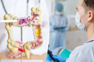 Home-based stool test cuts colon cancer deaths by half, study finds