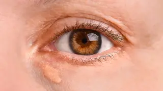 Eye Patches May Flag Higher Risk of Heart Attack and Stroke
