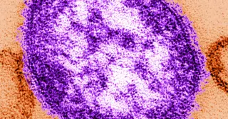 Six-Week-Old Infant Dies of Measles in Lancaster Outbreak