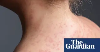 Pennsylvania Measles Outbreak Hits 1,004 Cases, Sparking Federal-Local Data Dispute