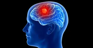 Tiny brain implant fights brain cancer with electrical therapy