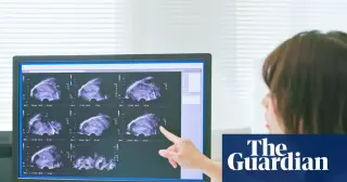 Light-up radiotracer could speed endometriosis diagnosis
