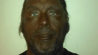 Reddit user warns Melanotan II users: it darkens skin slowly, offers no sun protection, and carries serious health risks