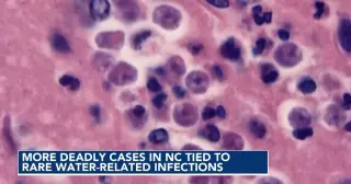 NC Labor Day Swim: Beware Brain-Eating Amoeba and Flesh-Eating Bacteria in Water