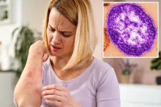 Wastewater signals measles in California, triggering health alert