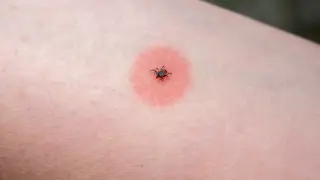 Lyme Disease Demystified: Early Signs, Prevention, and Prompt Treatment