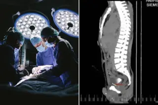 Self-Inserted Needles Found Throughout Man's Body, Including Near His Heart