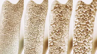 Large Review Finds Calcium and Vitamin D Supplements Do Not Significantly Prevent Falls or Fractures
