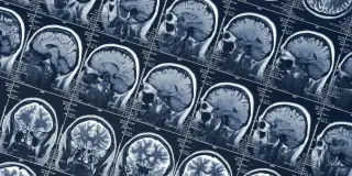 Shift Work Linked to Subtle Shrinkage in Amygdala and Thalamus, Reversible Upon Stopping
