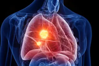 Targeting a Tumor's Mitochondrial Weakness Shows Promise Against Mesothelioma
