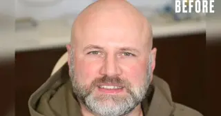 Twenty Veneers, a New Smile: A Man Regains Confidence