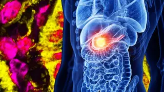 Breakthrough in Pancreatic Cancer Tests the Value of Federal Science Funding
