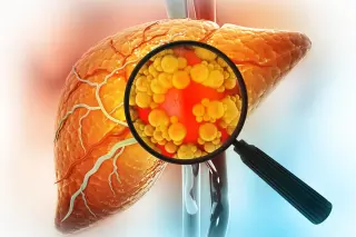 Eliminating senescent macrophages reverses fatty liver in mice
