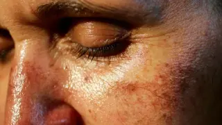 TikTok's illegal tanning drug Melanotan II sparks melanoma and erection risks