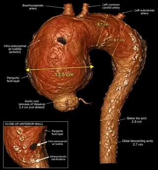 Surgeons Repair 13.5 cm Atherosclerotic Aortic Aneurysm in 70-Year-Old Woman